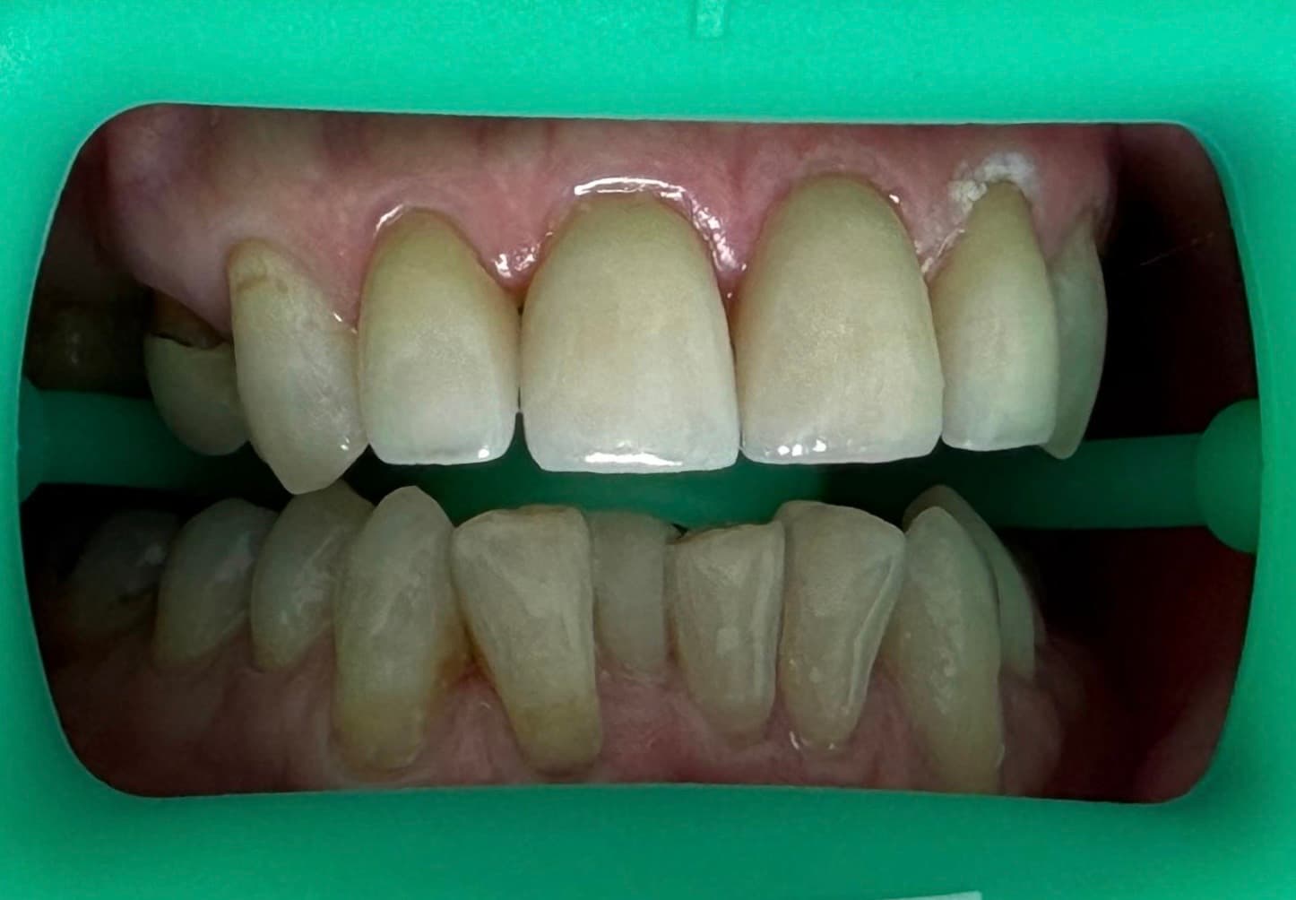 After: Whitening & crown
