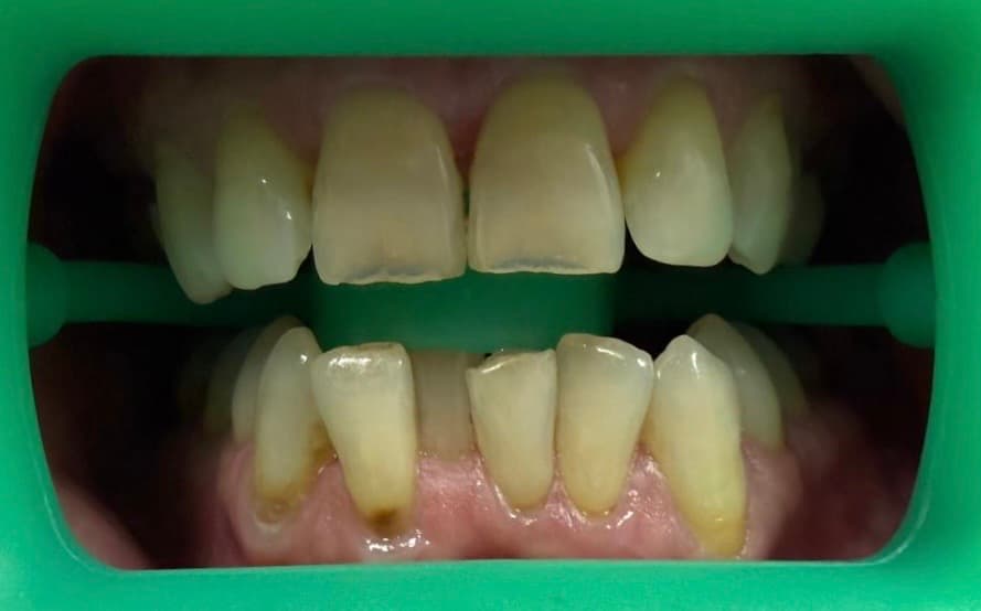 Before: Whitening & crown